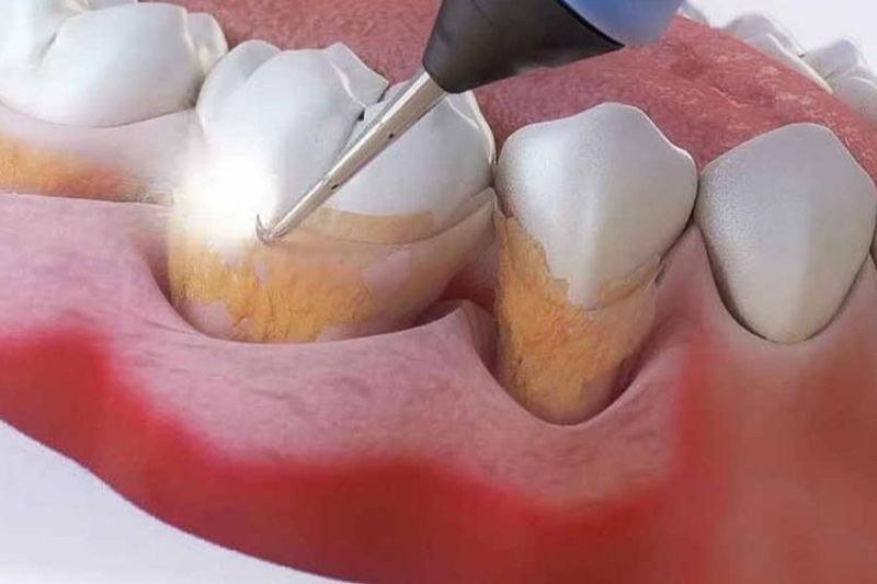 Bị tụt lợi có tự khỏi không? Cách chữa răng bị tụt lợi hiệu quả Trám cổ chân răng điều trị tụt lợi mức độ nhẹ