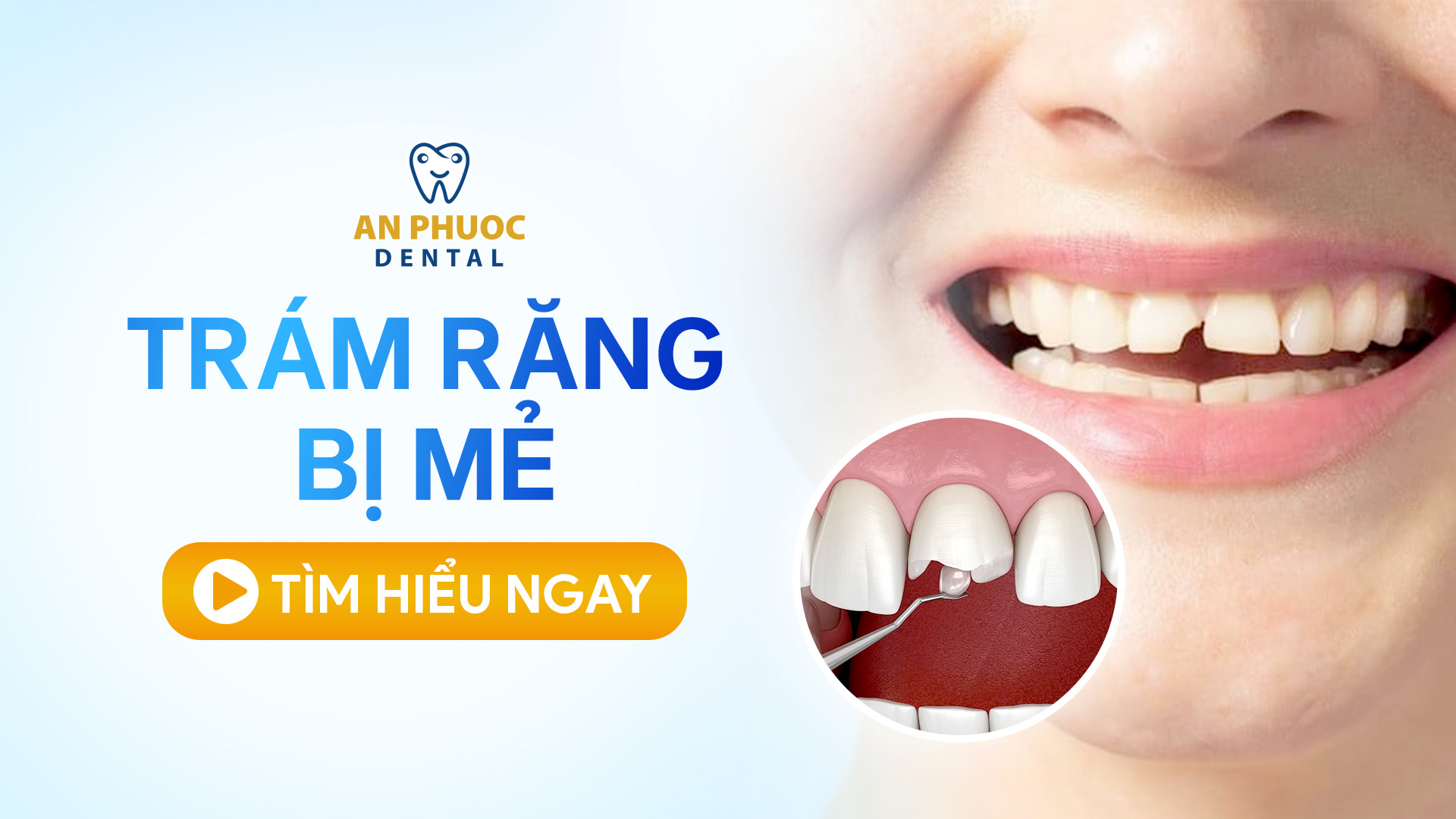 Trám răng mẻ có được không? Bảng giá trám răng chi tiết 2025 Trám răng bị mẻ