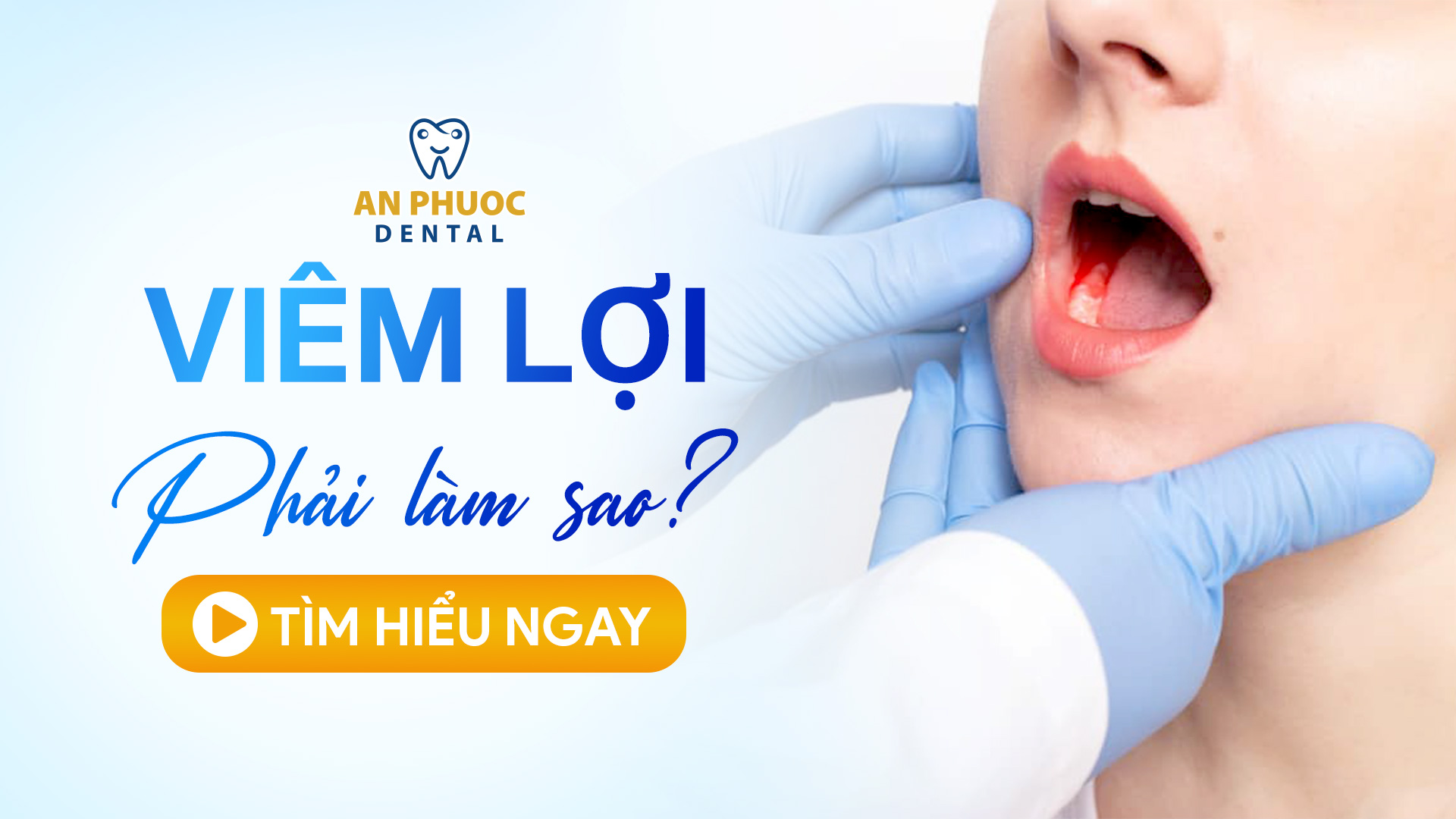 Viêm lợi là gì? Nguyên nhân, triệu chứng và cách điều trị hiệu quả Viêm lợi phải làm sao?