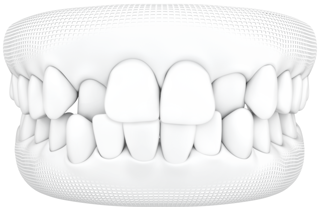 Niềng răng trong suốt mo-ta-khop-can-cheo