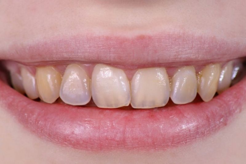 Mòn men răng là gì? Nguyên nhân và cách khắc phục kịp thời Mòn men răng có những biểu hiện khá rõ ràng