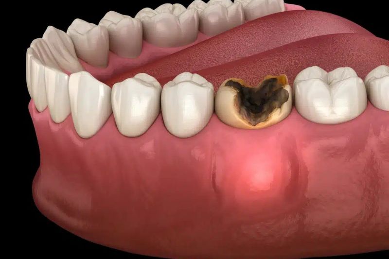 Trám răng sâu có bền không? Những câu hỏi thường gặp Răng sâu nặng trám răng được không?