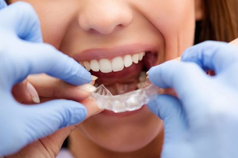 Mòn men răng là gì? Nguyên nhân và cách khắc phục kịp thời Sử dụng máng chống nghiến răng để tránh làm mòn men răng