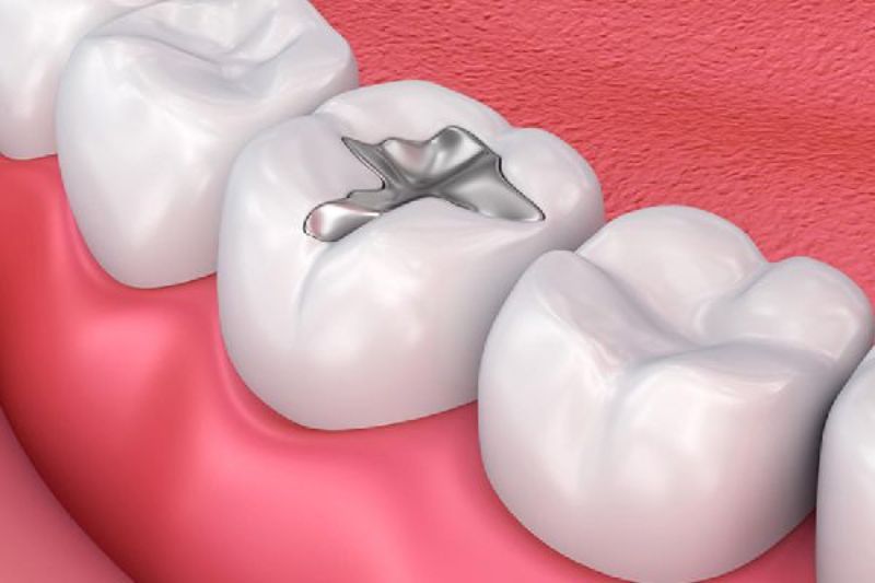 Trám răng sâu có bền không? Những câu hỏi thường gặp Trám răng bằng vật liệu Amalgam