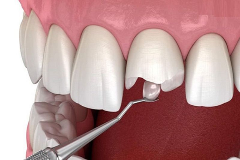 Trám răng sâu có bền không? Những câu hỏi thường gặp Trám răng bằng vật liệu Composite