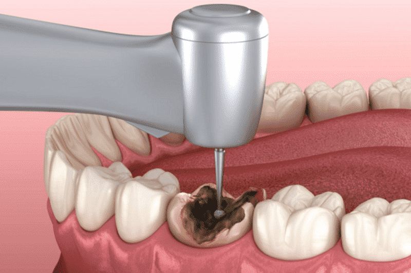 Trám răng sâu có bền không? Những câu hỏi thường gặp Trám răng sâu giúp khôi phục hình dáng và chức năng răng