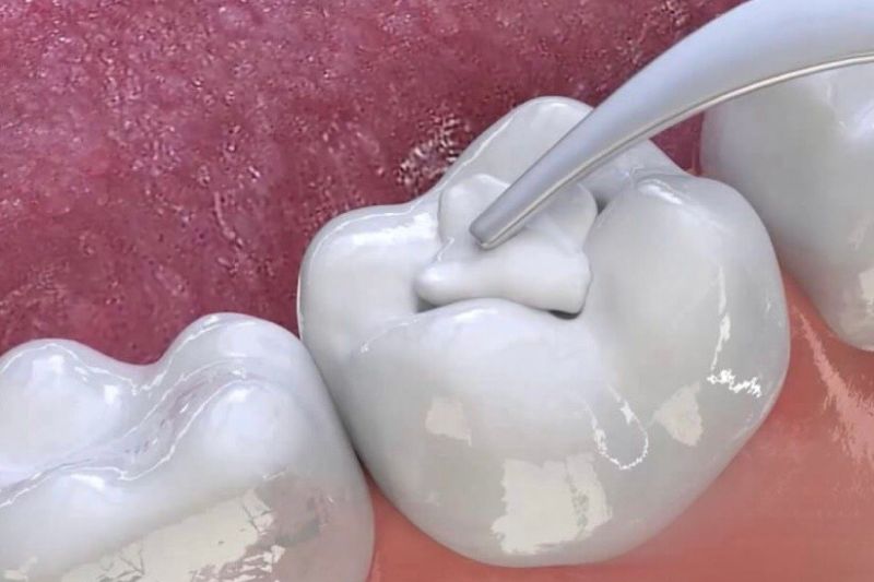 Trám răng sâu có bền không? Những câu hỏi thường gặp Trám răng sữa bằng vật liệu GIC