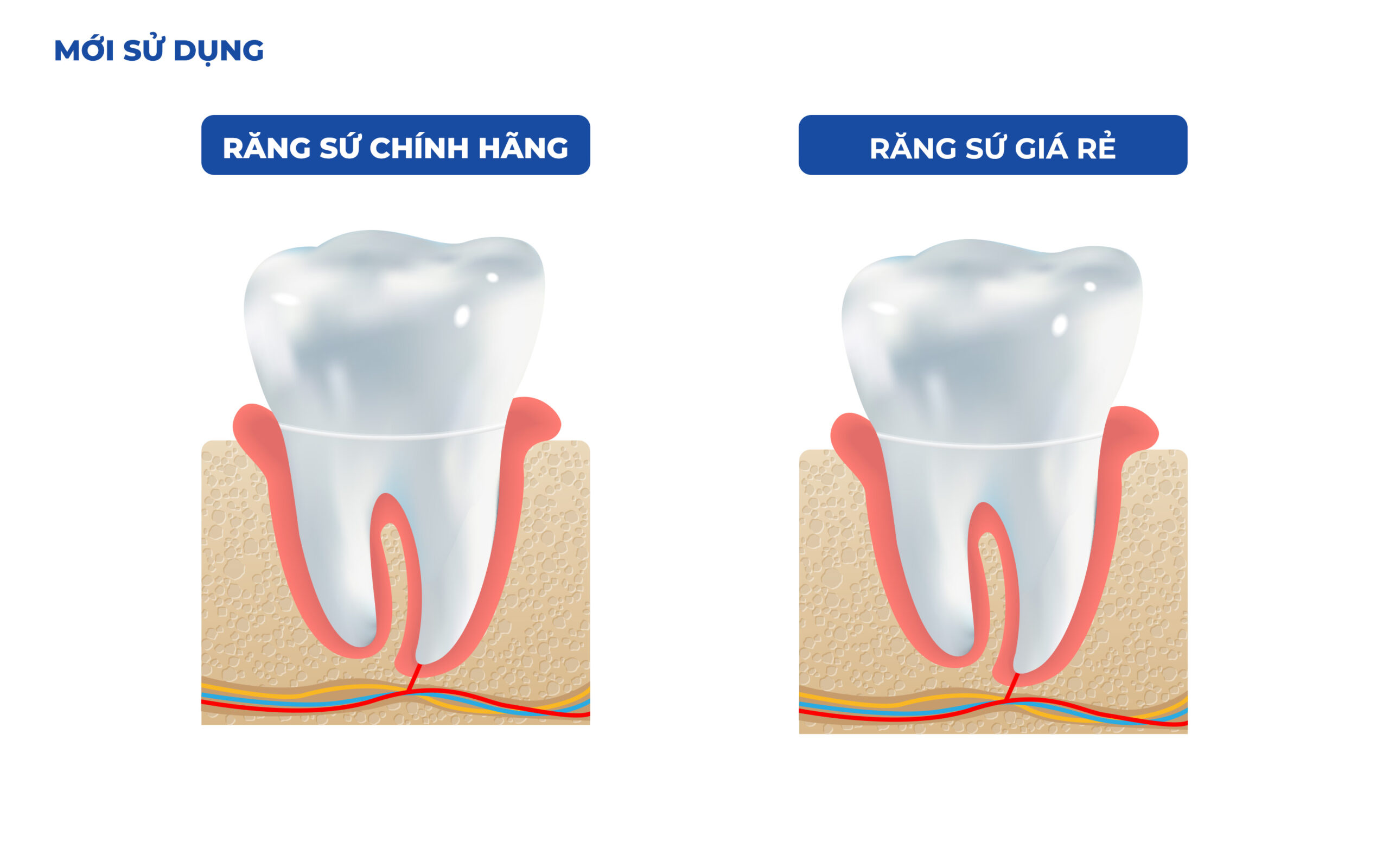 rang su bf scaled Tháng 4 15, 2026