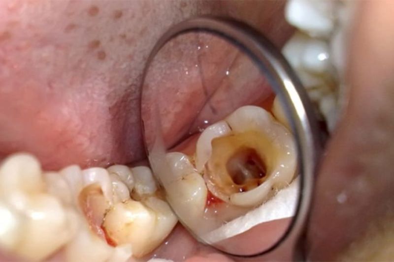 Răng bị sâu lỗ to có nguy hiểm không? Cách điều trị dứt điểm Răng bị sâu lỗ to gây ảnh hưởng đến sức khoẻ răng miệng và ăn nhai