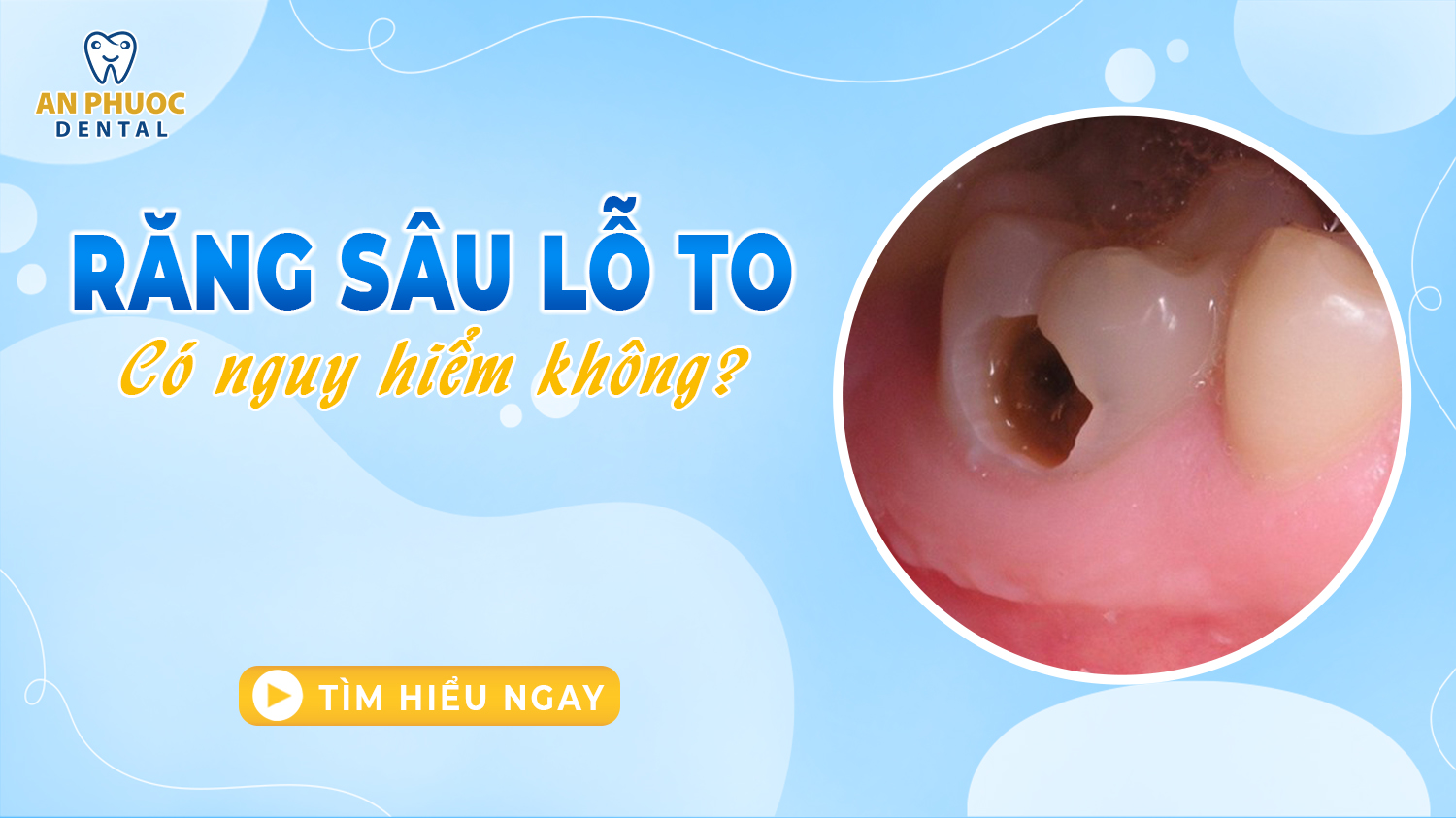 Răng bị sâu lỗ to có nguy hiểm không? Cách điều trị dứt điểm Răng bị sâu lỗ to có nguy hiểm không? Cách điều trị dứt điểm