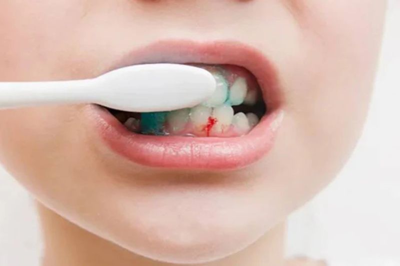 Viêm lợi ở trẻ em: Nguyên nhân, triệu chứng và cách điều trị hiệu quả Chảy máu khi đánh răng là biểu hiện dễ thấy của viêm lợi