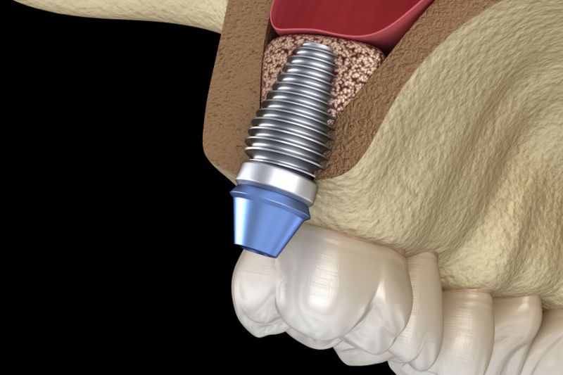 Kỹ thuật nâng xoang kín trong cấy ghép Implant