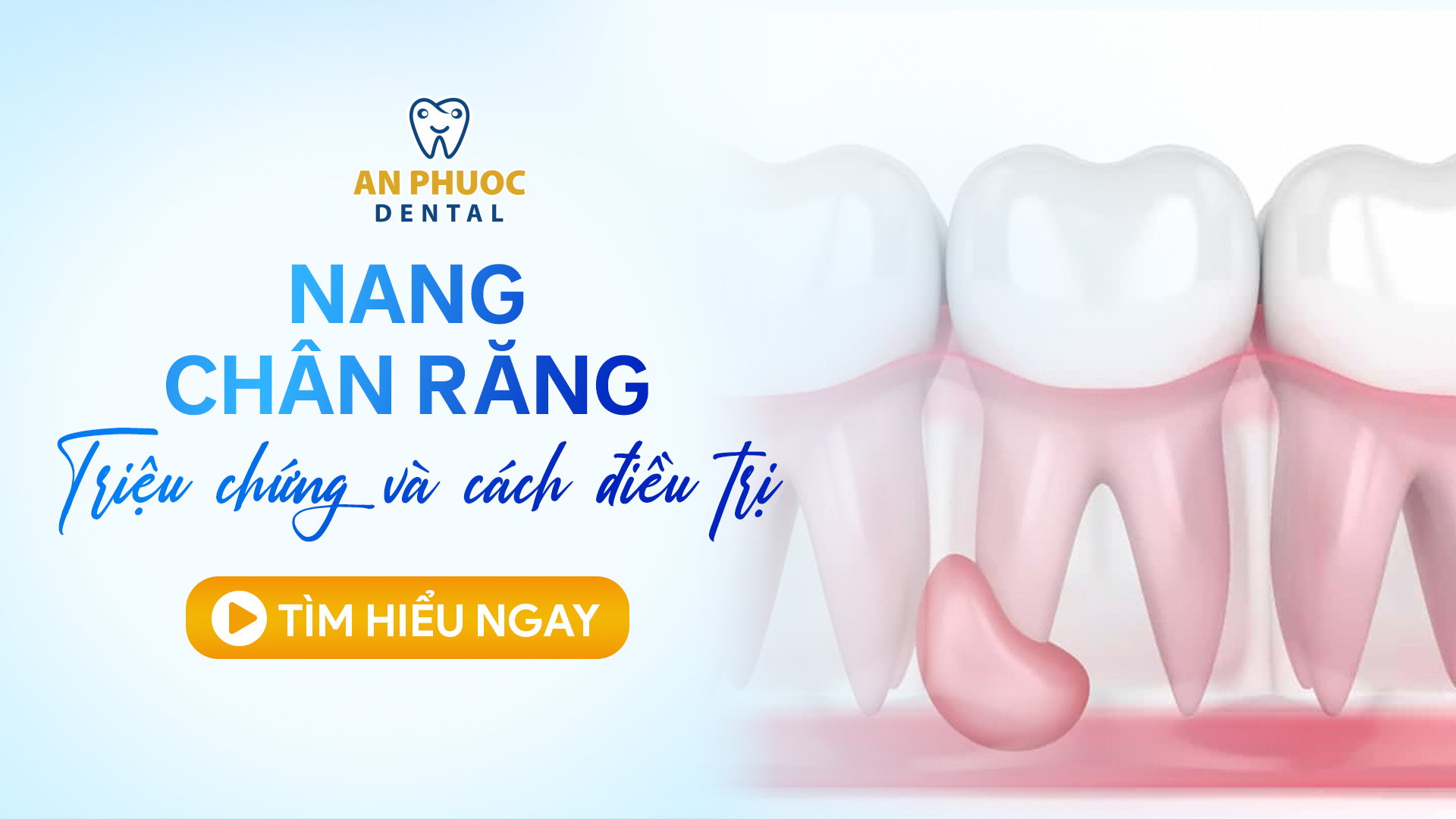 Bị nang chân răng có nguy hiểm không? Triệu chứng và cách điều trị Nang chân răng - Triệu chứng và cách điều trị