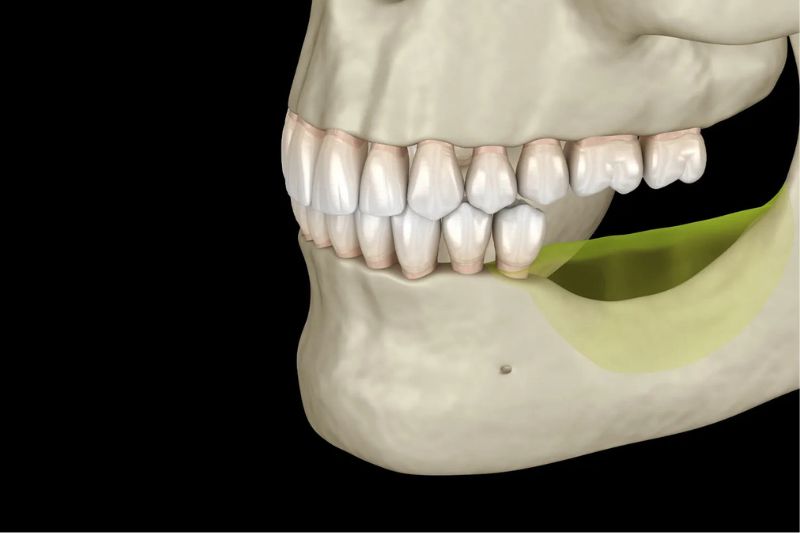 Nâng xoang kín khắc phục hiệu quả tình trạng tiêu xương hàm