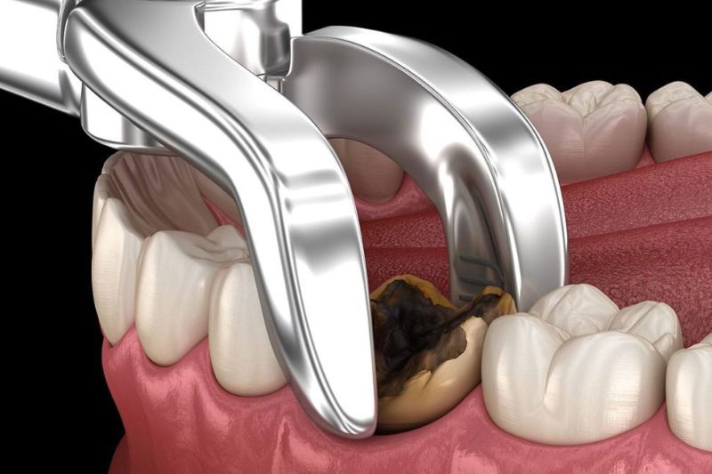 Răng cấm bị sâu: Nguyên nhân, hậu quả và cách điều trị hiệu quả Nhổ răng cấm khi bị sâu quá nặng