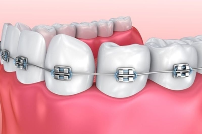Niềng răng mắc cài kim loại bao nhiêu tiền? Bảng giá mới nhất 2025 Niềng răng mắc cài kim loại truyền thống