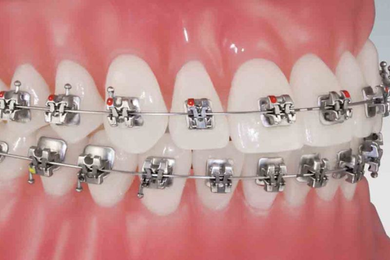 Niềng răng mắc cài kim loại bao nhiêu tiền? Bảng giá mới nhất 2025 Niềng răng mắc cài kim loại tự buộc