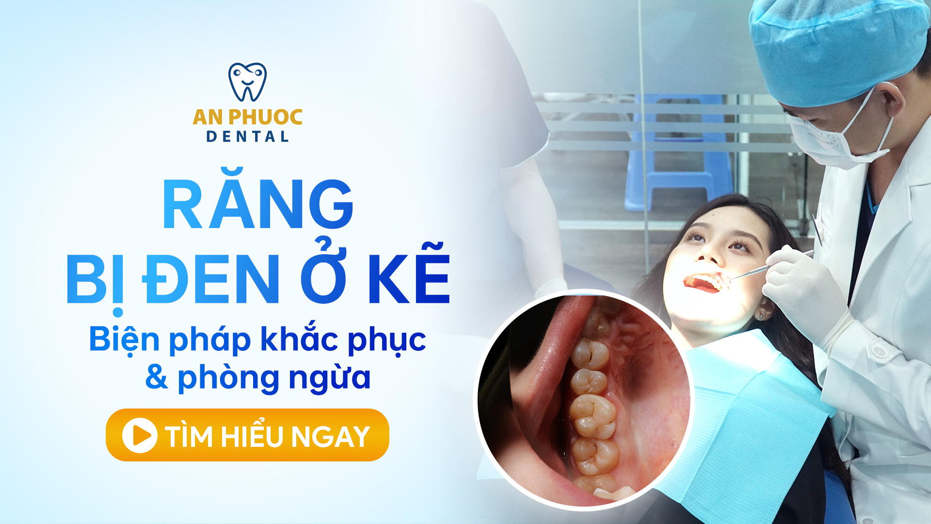 Khắc phục răng bị đen ở kẽ như thế nào? Biện pháp phòng ngừa Răng bị đen ở kẽ - Biện pháp khắc phục và phòng ngừa