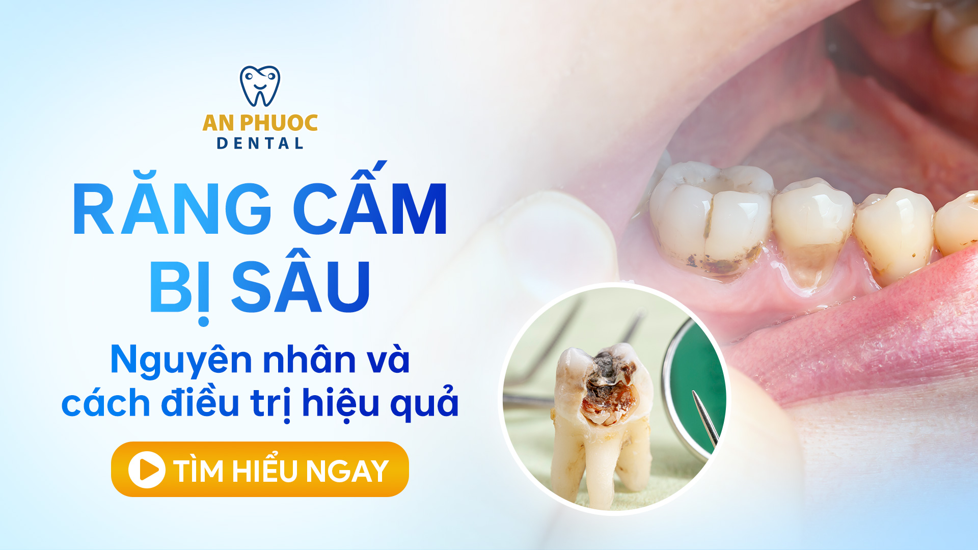 Răng cấm bị sâu - Nguyên nhân và cách điều trị hiệu quả