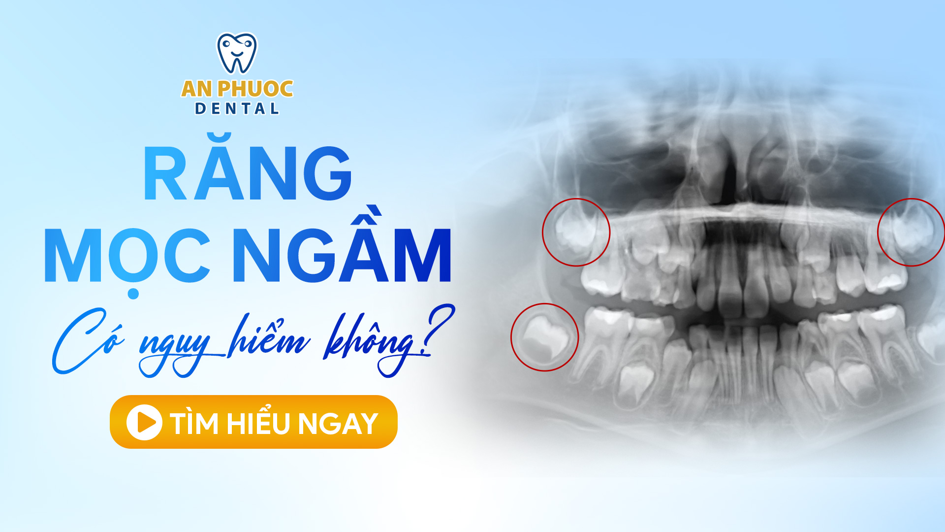 Răng mọc ngầm hàm trên/dưới có cần nhổ không? Có nguy hiểm? Răng mọc ngầm có nhổ được không?