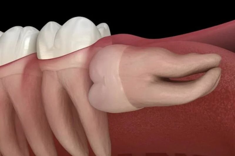 Răng mọc ngầm gây ảnh hưởng đến chân răng bên cạnh
