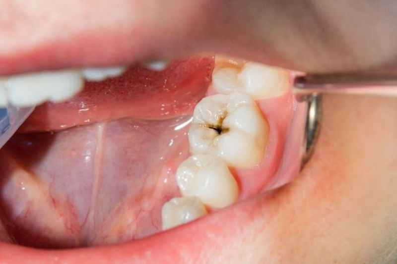 Răng cấm bị sâu: Nguyên nhân, hậu quả và cách điều trị hiệu quả Tình trạng răng cấm bị sâu