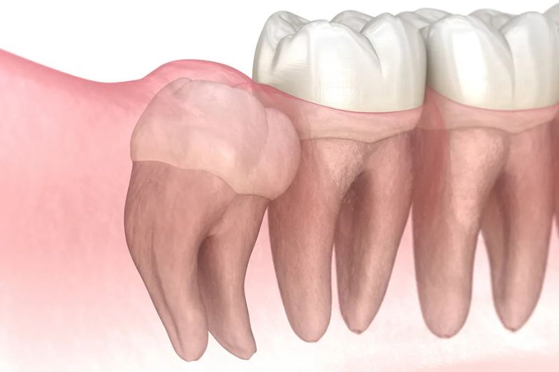 Tình trạng răng mọc ngầm