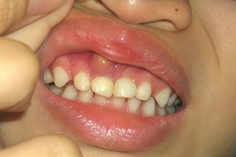Viêm lợi ở trẻ em: Nguyên nhân, triệu chứng và cách điều trị hiệu quả Viêm lợi nặng gây sưng đau và có mủ