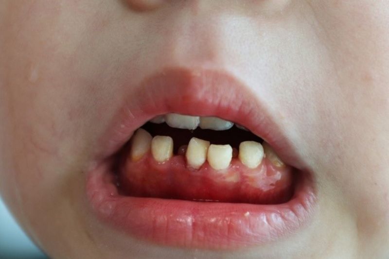 Viêm lợi ở trẻ em: Nguyên nhân, triệu chứng và cách điều trị hiệu quả Viêm lợi ở trẻ em - Nguyên nhân do đâu?