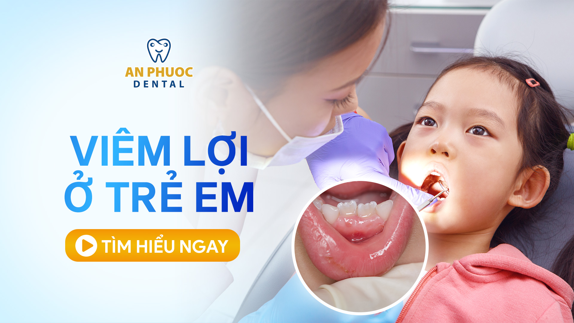 Viêm lợi ở trẻ em