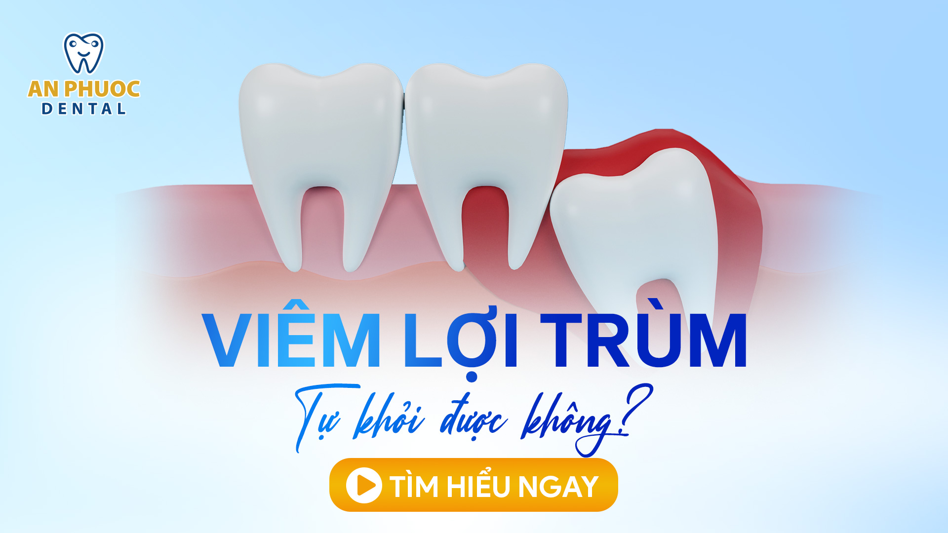 Viêm lợi trùm là gì? Ảnh hưởng thế nào? Tự khỏi được không? Viêm lợi trùm ảnh hưởng như thế nào