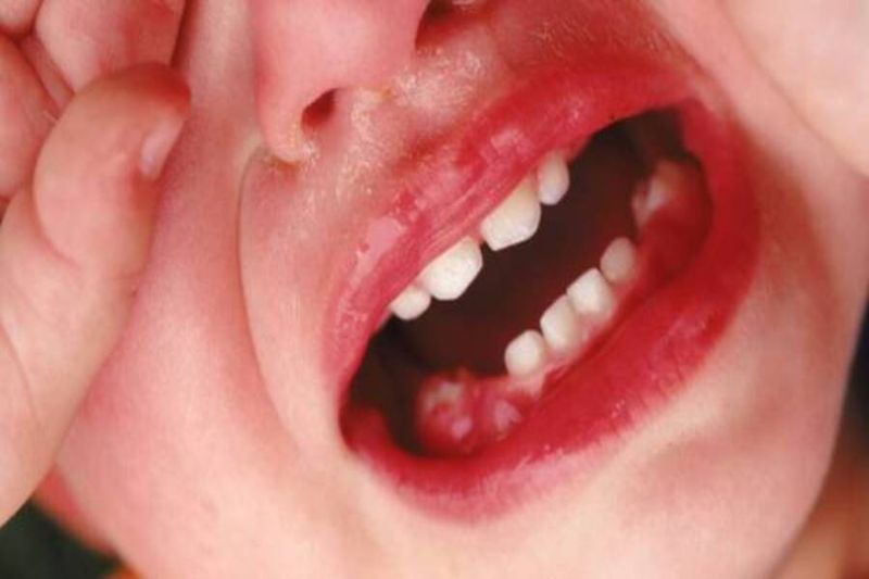 Viêm lợi ở trẻ em: Nguyên nhân, triệu chứng và cách điều trị hiệu quả Viêm nha chu nghiêm trọng ở trẻ em
