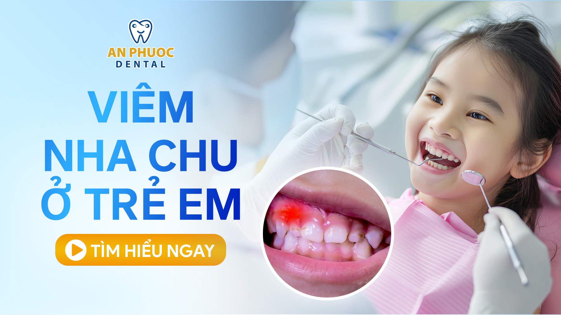 Viêm nha chu ở trẻ em do đâu? Nhận biết & Cách điều trị Viêm nha chu ở trẻ em