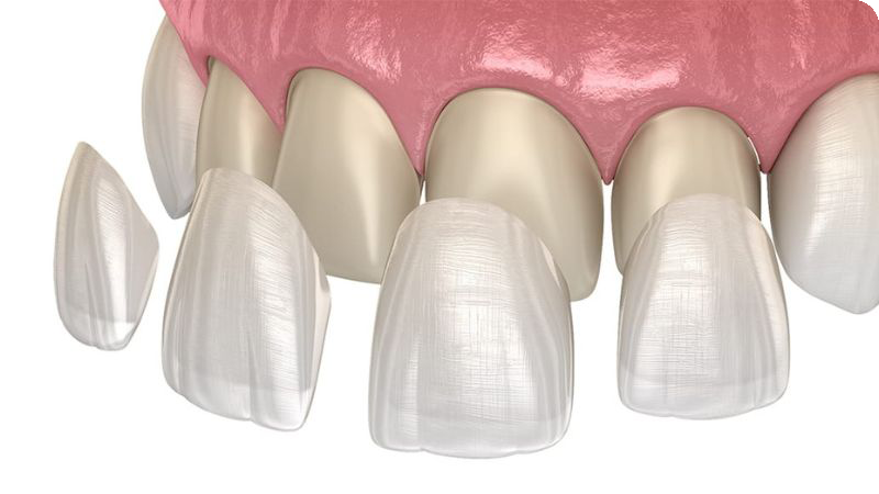 Bảng giá răng sứ thẩm mỹ 2025 Minh hoa Mat dan su Veneer Tháng 10 16, 2025