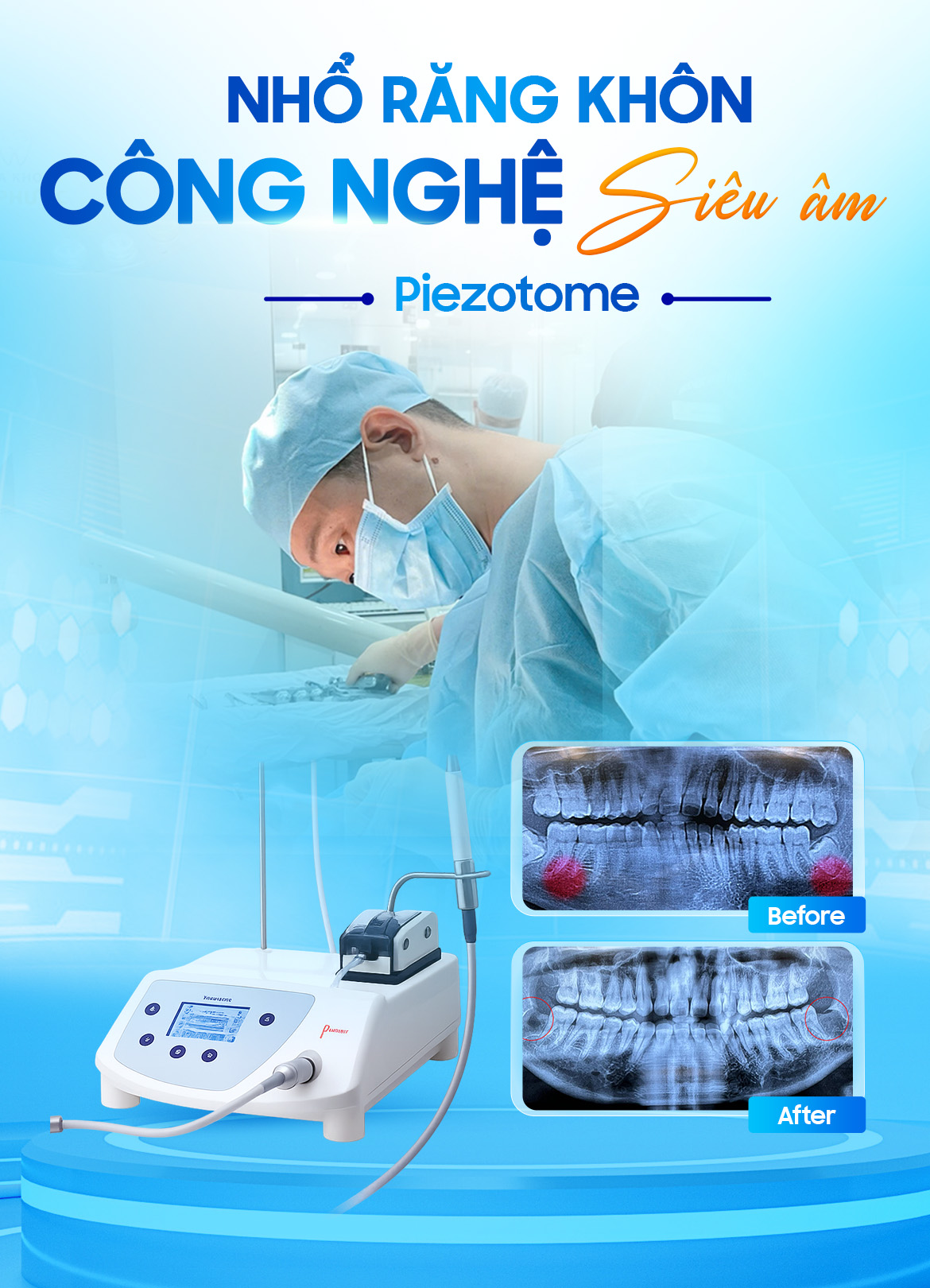Nhổ răng khôn công nghệ sóng siêu âm An Phước