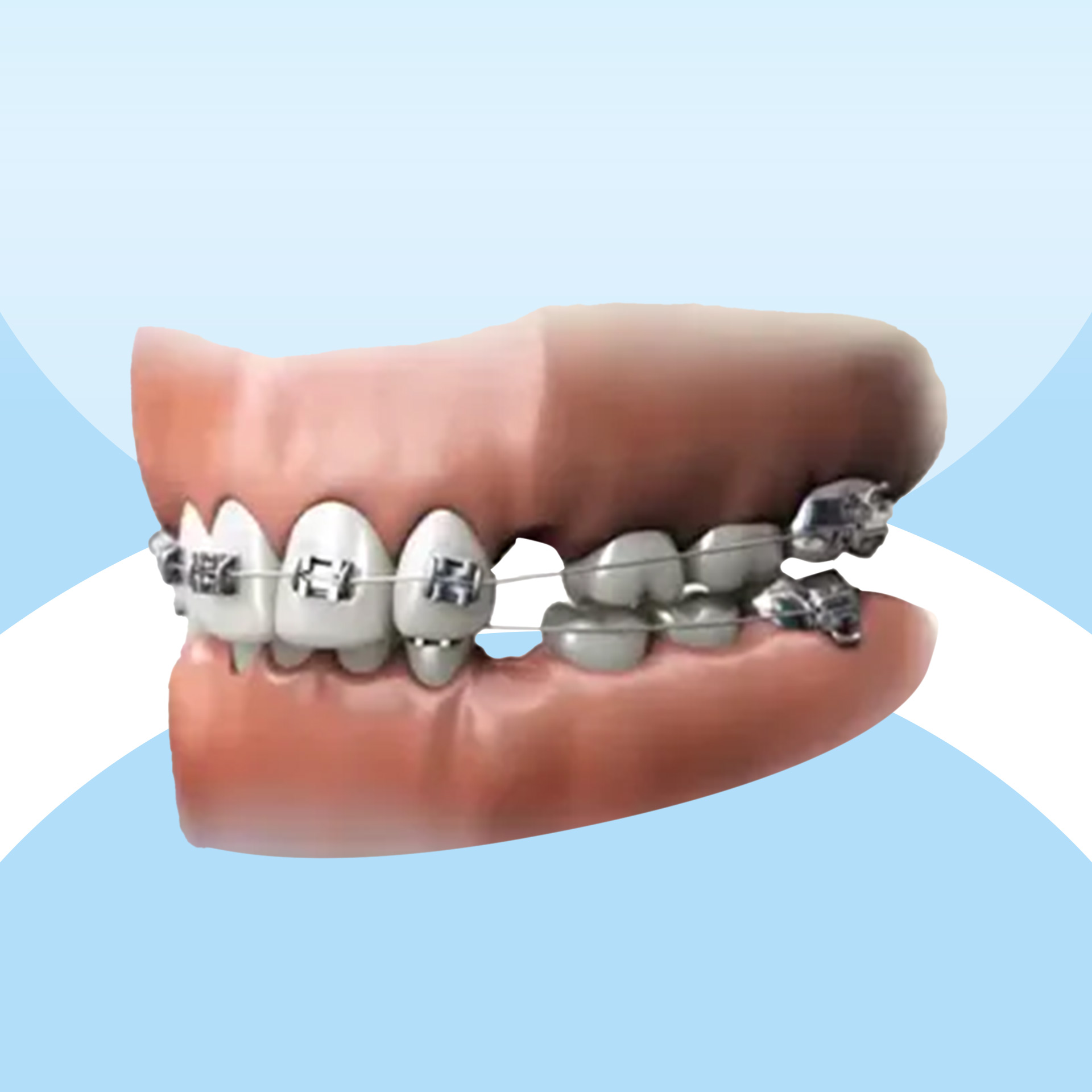 Niềng răng trẻ em - Khí cụ 2x4