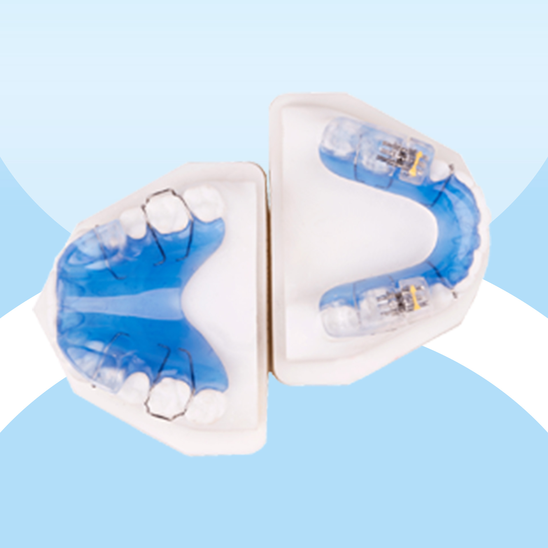 Niềng răng trẻ em - Khí cụ Twinblock