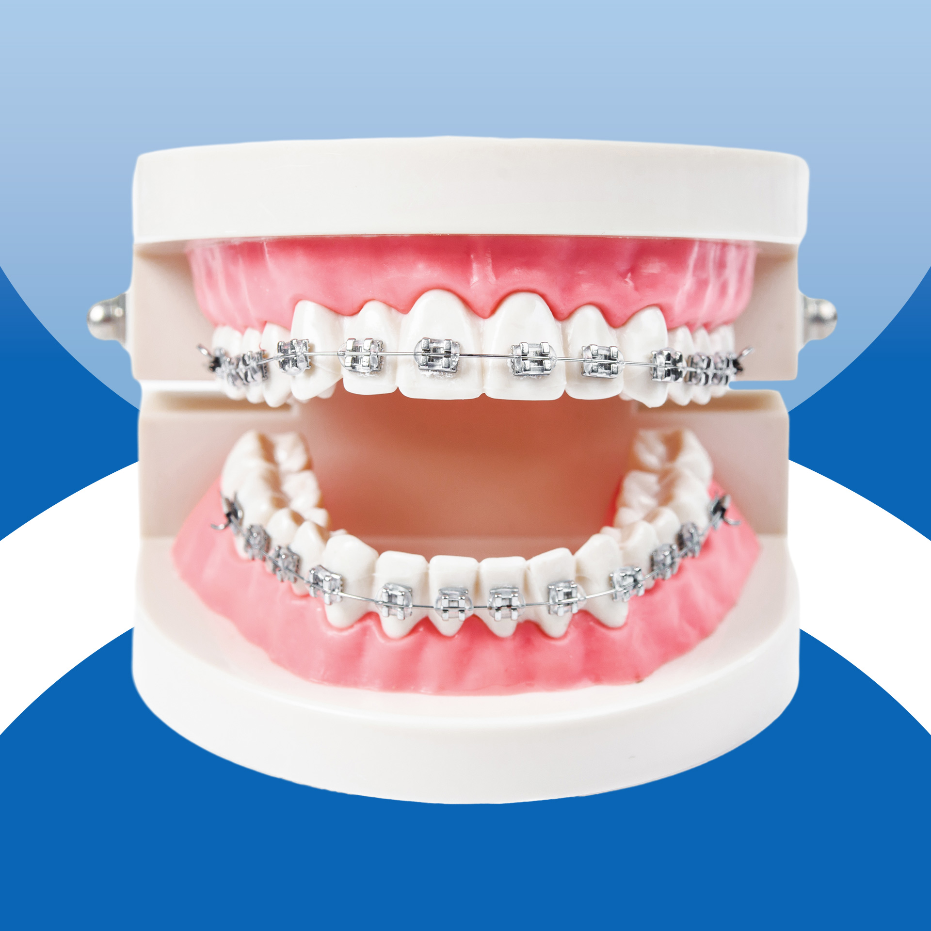 Niềng răng trẻ em -Mắc cài kim loại