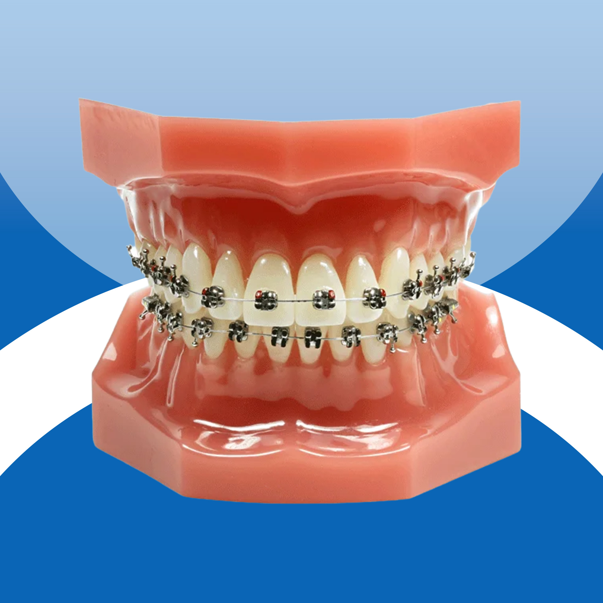 Niềng răng trẻ em - Mắc cài kim loại tự buộc