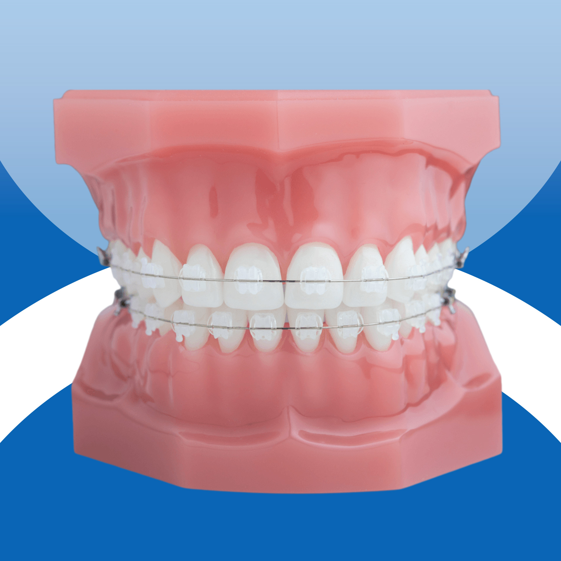 Niềng răng trẻ em - Mắc cài sứ